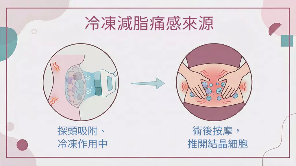 冷凍減脂痛感來源