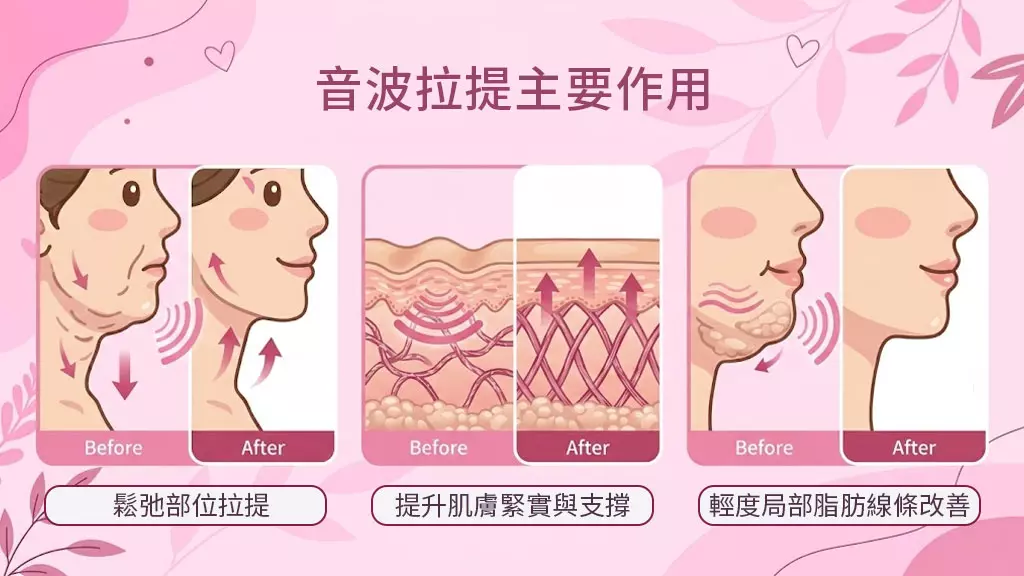 音波拉提主要作用